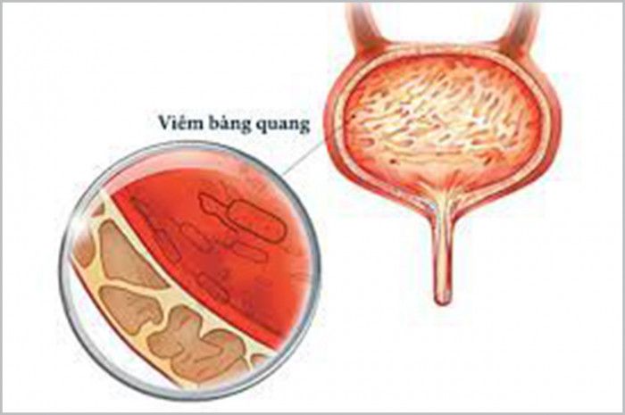 Viêm bàng quang cấp có thể tái đi tái lại?