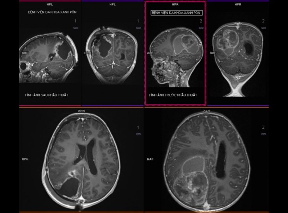 9 dấu hiệu cảnh báo u não ở trẻ em, cha mẹ chớ bỏ qua