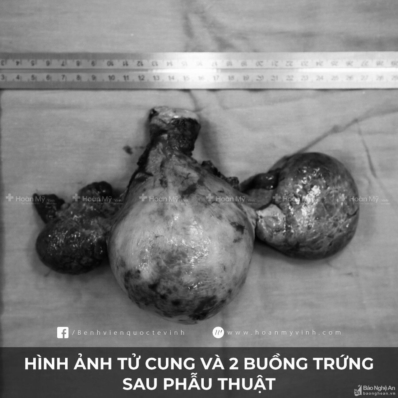 Ung thư buồng trứng - căn bệnh phụ nữ nào cũng có thể mắc phải