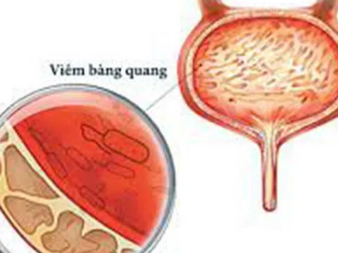 Viêm bàng quang cấp có thể tái đi tái lại?