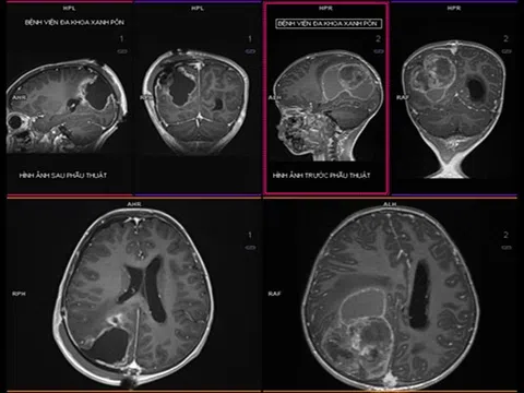 9 dấu hiệu cảnh báo u não ở trẻ em, cha mẹ chớ bỏ qua