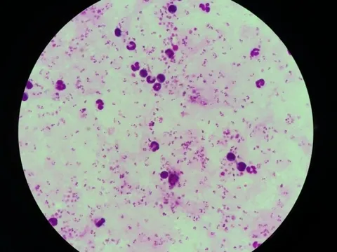 Hai người Việt từ châu Phi về bị sốt rét ác tính