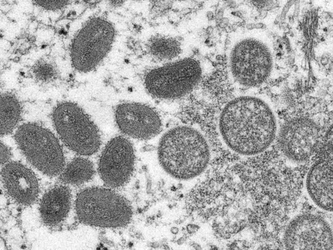 Chủng virus đậu mùa khỉ đang lây lan toàn cầu có 47 đột biến mới