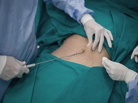 Người phụ nữ 50 tuổi tử vong sau 3 ngày hút mỡ bụng