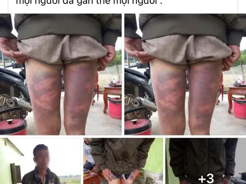 Vụ dân tố bị còng tay đánh bầm tím ở trụ sở xã: Người nhà công an xã mang 5 triệu đến?