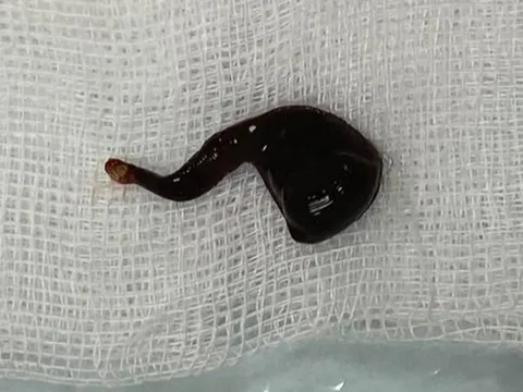 Hà Tĩnh: Đỉa 5cm "làm tổ" trong mũi nam thanh niên gần cả tháng