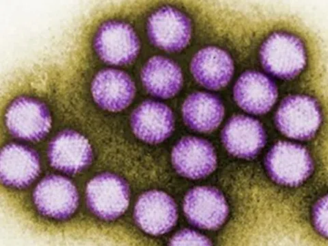 6 trẻ tử vong do virus Adeno: Biến chứng nguy hiểm sao?