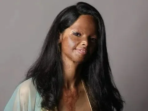 Ấn Độ đau đầu với nạn tạt axit