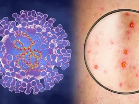 Tăng cường phòng chống bệnh Đậu mùa khỉ trên địa bàn tỉnh Nghệ An