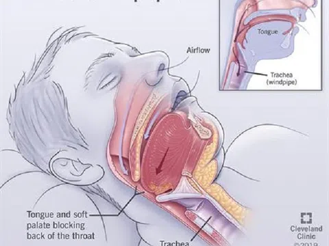 Biến chứng nguy hiểm của hội chứng ngưng thở khi ngủ