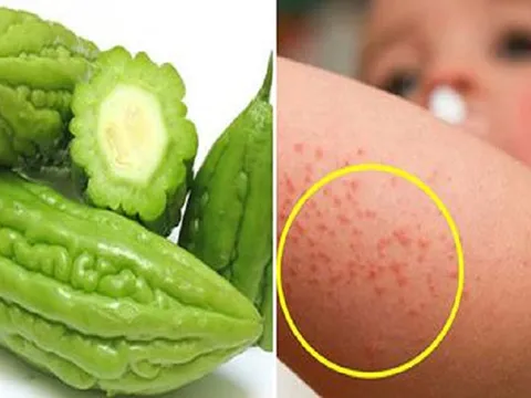 Làm gì để phòng tránh rôm sảy cho trẻ?