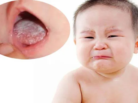 Bé bị tưa miệng nhỏ chanh, mật ong, được không?