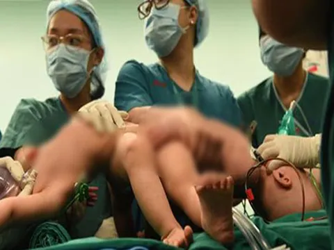Đang tiến hành phẫu thuật tách dính 2 bé gái song sinh: Bố mẹ con đã khóc, mọi người đều mong các con được bình an