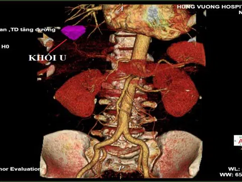 Chàng trai 28 tuổi ung thư gan sau hơn 10 năm làm điều mà hầu như thanh niên nào cũng mắc phải