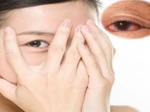 Bệnh đau mắt đỏ nên kiêng ăn gì?