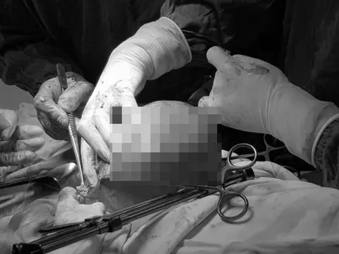 Khối u xơ tử cung "lớn nhanh như thổi" vì 3 năm liền tin dùng thực phẩm chức năng